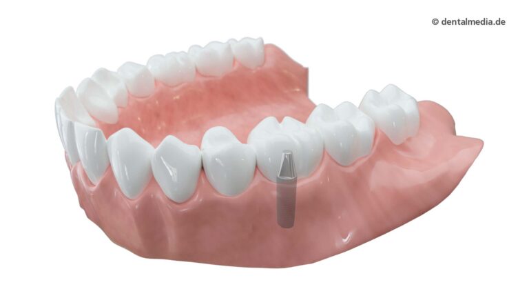 Zahnkronen aus Vollkeramik | Fachzahnarzt für Oralchirurgie in Marl
