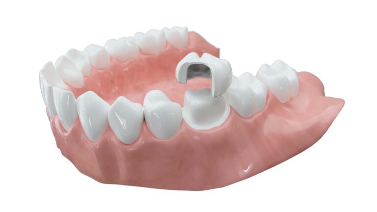 Zahnkronen aus Keramik | Fachzahnarzt für Oralchirurgie in Marl