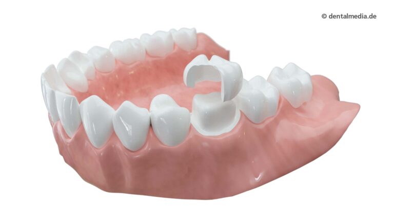 Zahnkronen aus Vollkeramik | Fachzahnarzt für Oralchirurgie in Marl