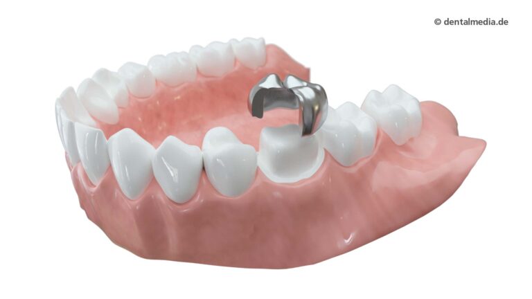 Zahnkronen aus Metall | Fachzahnarzt für Oralchirurgie in Marl