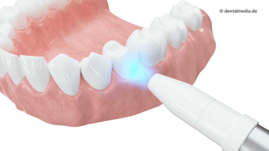Laser Bleaching | Fachzahnarzt für Oralchirurgie in Marl