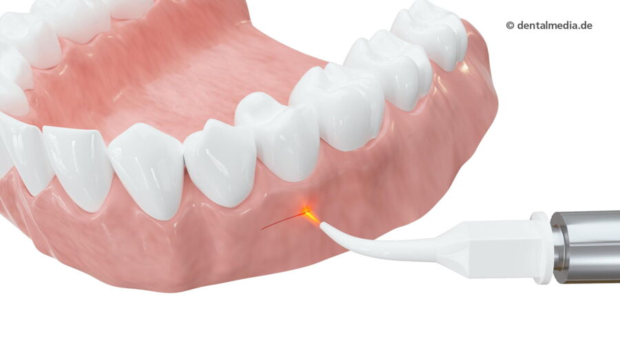 Laser Cut | Fachzahnarzt für Oralchirurgie in Marl