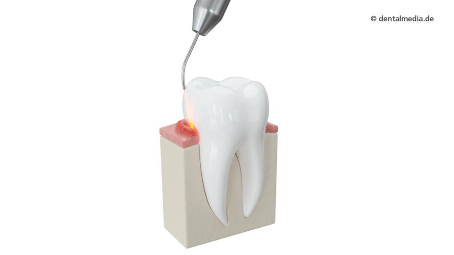 Laser Parodontie | Fachzahnarzt für Oralchirurgie in Marl